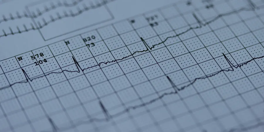 Traçado impresso de eletrocardiograma em papel milimetrado, exame de eletrocardiograma em criança